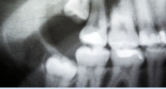 Osteoporoza: Impactul Ascuns asupra Sanatatii Dentare