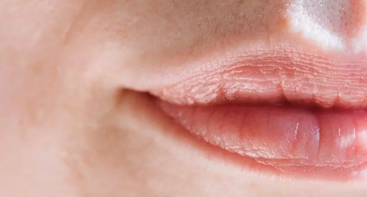 Herpes bucal - patologie si tratare