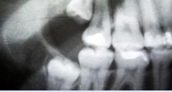 aspect-osteoporoza-pe-radiografie-opg