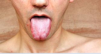 limba si cavitate orala infectate cu candida ce necesita tratament